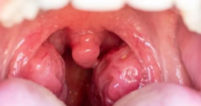 “Tonsilektomi: Operasi Amandel yang Sering Dianggap Horor Padahal Lebih Drama Ketimbang Nyata”